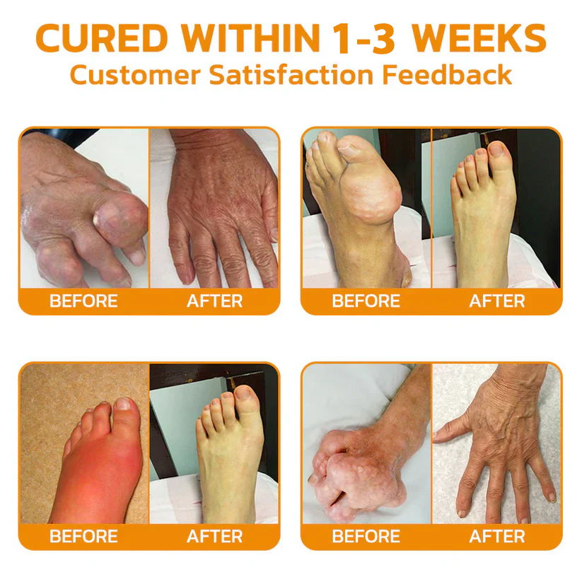 ✅Official Store: LOVILDS™ Bees Pain-Relief Bone Healing Cream👨⚕️USA Osteopathic Medical Association (AAOS)Approved(Reducing joint swelling, pain, stiffness, redness, warmth, soreness, and joint fatigue)